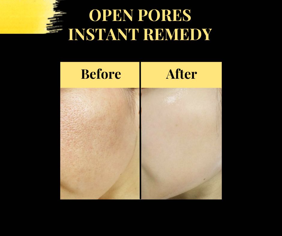 How to Achieve a Glowing Complexion by Closing Open Pores