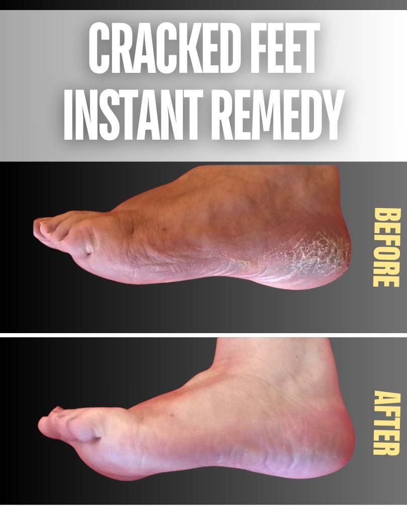 Instant Remedies for Cracked Feet