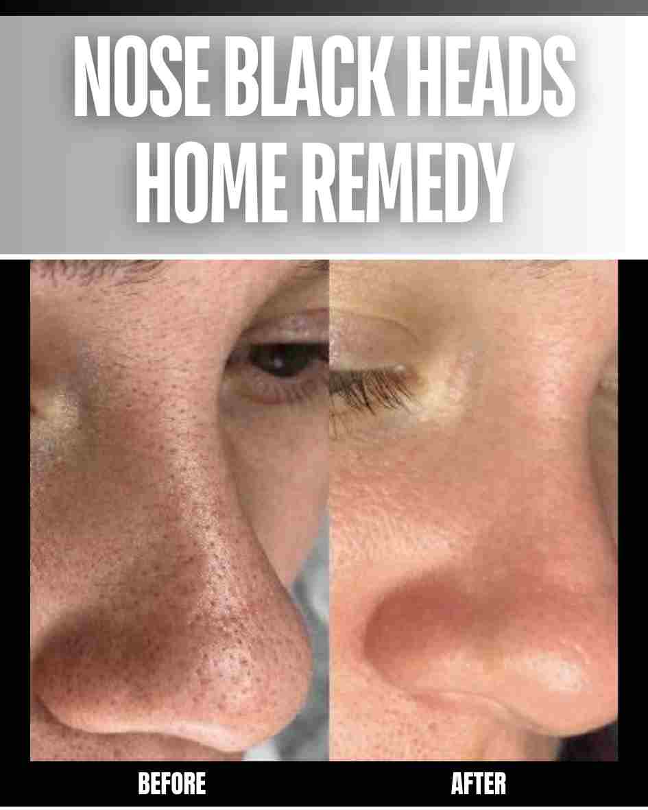 Home Remedies for Nose Blackheads