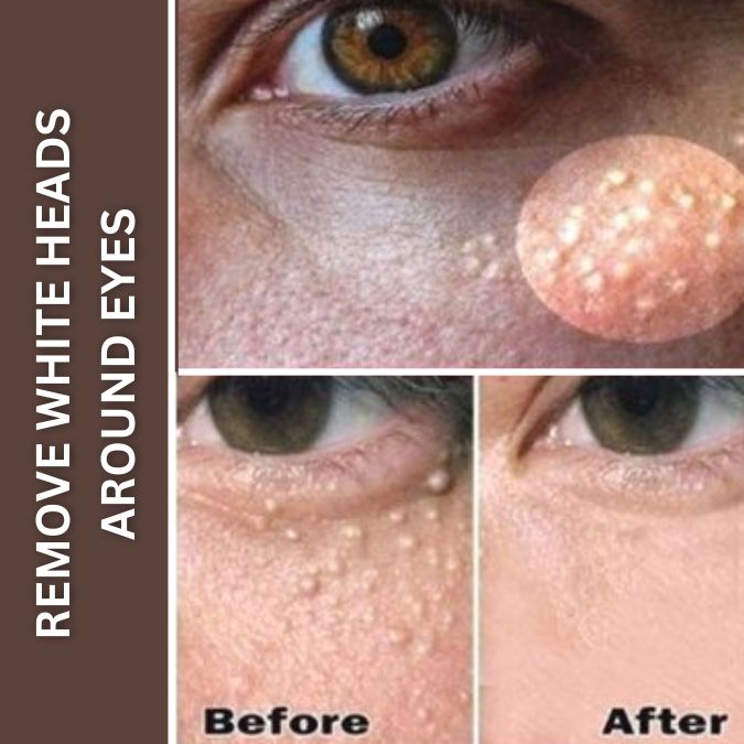 Effective Home Remedies to Remove Whiteheads Around Eyes