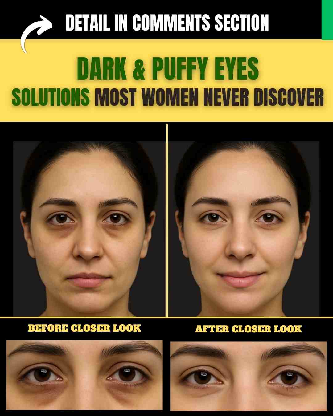 **DARK & PUFFY EYES SOLUTIONS MOST WOMEN NEVER DISCOVER** *(Includes Diet Plan + Hidden Causes)* *Word Count: Approx. 1500 Words* --- ### **Introduction:** Dark circles and puffy eyes often sneak into our lives quietly but leave a lasting impact on how we look and feel. While makeup might cover them briefly, real, long-term solutions lie in understanding their hidden causes and using natural, science-backed remedies tailored to different skin types. Let’s explore gentle but powerful home remedies for every skin type and a complete diet plan to help you regain bright, youthful eyes—without chemicals. --- ## **Common Hidden Causes Most Women Don’t Know** 1. **Late-Night Screen Exposure** – Blue light affects melatonin production, disturbing sleep and causing puffiness. 2. **Iron Deficiency** – Poor oxygenation makes under-eye veins appear darker. 3. **Chronic Sinus Congestion** – Leads to fluid retention and puffiness. 4. **Poor Lymphatic Drainage** – Often from sleeping flat or dehydration. 5. **Overuse of Eye Creams** – Thick products can clog under-eye tissue, worsening puffiness. 6. **Rubbing Eyes Too Often** – Breaks tiny capillaries, leading to pigmentation. 7. **Uncontrolled Allergies** – Release of histamine causes swelling and darkening. --- ## **Remedy 1: For Normal Skin** **Ingredients:** * 1 tsp cold cucumber juice (hydrates, anti-inflammatory) * ½ tsp potato juice (natural bleaching agent) * 1 pinch turmeric (curcumin lightens dark circles) * 1 tsp aloe vera gel (soothes skin and depuffs) * 1 tsp chilled rose water (hydrates and tightens skin) * 1 drop almond oil (rich in Vitamin E) * 1 tsp raw milk (mild exfoliator) **Procedure:** 1. Mix all ingredients in a small bowl and chill for 10 minutes. 2. Soak cotton pads in the mixture. 3. Place them over closed eyes for 15–20 minutes. 4. Remove and pat gently with a cool, damp cloth. **How Often to Apply:** Daily for 7 days, then alternate days. **Initial Results:** Noticeable freshness and reduced puffiness in 2–3 days. Dark circles start fading within a week. --- ## **Remedy 2: For Combination Skin** **Ingredients:** * 1 tsp grated raw potato (lightens pigmentation) * ½ tsp green tea (reduces swelling due to tannins) * 1 tsp yogurt (contains lactic acid for mild exfoliation) * 1 pinch of cinnamon powder (improves circulation) * ½ tsp honey (hydrates and reduces darkness) * 1 tsp cucumber pulp (calms inflammation) **Procedure:** 1. Mix all ingredients into a paste. 2. Apply gently under and over closed eyes using fingertips. 3. Leave on for 10 minutes, then rinse with cool water. **How Often to Apply:** 3–4 times a week. **Initial Results:** Eyes appear less tired and more hydrated within 3 days. Dark circles begin lightening in a week. --- ## **Remedy 3: For Oily Skin** **Ingredients:** * 1 tsp fresh tomato juice (lycopene helps reduce discoloration) * 1 tsp multani mitti (absorbs excess oil, tightens skin) * ½ tsp lemon juice (Vitamin C brightens skin tone) * ½ tsp witch hazel (natural astringent) * 1 tsp aloe vera (hydrates without oil) * ½ tsp rice water (boosts collagen and circulation) **Procedure:** 1. Combine all ingredients to form a thick paste. 2. Apply a thin layer under eyes. 3. Let it dry for 10 minutes. 4. Rinse off gently using cold water. **How Often to Apply:** Every alternate day. **Initial Results:** Reduction in oiliness and puffiness within 2 uses. Skin under the eyes feels firmer in 4–5 days. --- ## **Remedy 4: For Dry Skin** **Ingredients:** * 1 tsp almond paste (Vitamin E-rich skin nourisher) * 1 tsp cold raw milk (brightens and soothes) * ½ tsp mashed avocado (fatty acids repair dryness) * 1 tsp castor oil (hydrates deeply and boosts circulation) * ½ tsp rosehip oil (rich in retinoids) * 1 pinch turmeric (lightens skin) **Procedure:** 1. Mix ingredients into a creamy mask. 2. Gently apply with ring fingers around the eyes. 3. Leave on for 15 minutes, then dab off with a cool, wet cloth. **How Often to Apply:** Every night before sleep. **Initial Results:** Dryness disappears in 2 days. Eyes feel less itchy and dark circles gradually reduce in a week. --- ## **Remedy 5: For Sensitive Skin** **Ingredients:** * 1 tsp chamomile tea (calms inflammation) * 1 tsp cucumber juice (cools and depuffs) * 1 tsp calendula oil (anti-inflammatory, gentle healer) * 1 tsp aloe vera (safe for sensitive skin) * 1 tsp goat milk (rich in gentle lactic acid) * 1 drop Vitamin E oil (restores skin) **Procedure:** 1. Brew chamomile tea and let it cool. 2. Mix with other ingredients and soak cotton pads. 3. Place on eyes for 10–15 minutes. 4. Pat gently with a damp cloth. **How Often to Apply:** 3–5 times a week. **Initial Results:** Instant cooling and calming effect. Puffiness and mild irritation disappear within 2 days. --- ## **Complete Weekly Diet Plan to Reduce Dark Circles & Puffiness** ### 🌞 **For Normal Individuals:** **Morning:** * 1 glass lukewarm water with lemon * 5 soaked almonds * 1 boiled egg or multigrain toast **Mid-Morning:** * 1 orange or apple * Green tea (antioxidants) **Lunch:** * Mix sabzi + 1 bowl curd + 1 roti * 1 glass water 30 mins before, not after meals **Evening Snack:** * Roasted chickpeas or makhanas * 1 herbal tea (chamomile or mint) **Dinner:** * Moong dal + steamed vegetables + brown rice * 1 tsp flaxseeds after dinner **Before Bed:** * Warm milk with pinch of turmeric --- ### 🌿 **For Diabetic Individuals:** **Morning:** * 1 tsp methi seeds soaked overnight * 1 boiled egg or oats with cinnamon **Mid-Morning:** * 1 guava or half papaya * Herbal tea (no sugar) **Lunch:** * Mix sabzi (no potatoes) + whole grain roti + salad + lemon juice **Evening Snack:** * Roasted black chana + green tea **Dinner:** * Grilled fish or daal + sautéed vegetables * 1 tsp chia seeds soaked in water **Before Bed:** * Lukewarm water + pinch of cinnamon --- ### ❤️ **For Individuals with High Blood Pressure:** **Morning:** * 1 banana or boiled beetroot * 1 tsp flaxseed powder in water **Mid-Morning:** * Coconut water or cucumber slices * Avoid salt-rich snacks **Lunch:** * Low-salt vegetable curry + brown rice or roti * Mixed salad with olive oil and lemon **Evening Snack:** * 1 boiled egg white or low-fat yogurt **Dinner:** * Moong dal soup + boiled vegetables * 1 glass of warm water with tulsi leaves **Before Bed:** * Chamomile tea --- ## **Final Tips for Brighter, Tighter Eyes:** * **Stay Hydrated:** Drink at least 8–10 glasses of water daily. * **Sleep Smart:** Elevate your head slightly to reduce eye puffiness. * **Sleep on Time:** Aim for 6–8 hours of consistent sleep (preferably before midnight). * **Do a Patch Test:** Especially for sensitive skin, test remedies before full application. * **Avoid Harsh Rubbing:** Be gentle when removing makeup or applying remedies. * **Cool Compress Daily:** Even plain chilled green tea bags work wonders. * **Clean Tools:** Always use clean fingers, cotton pads, or brushes near the eye. --- **Visible results begin within 2–3 days of consistent care, and natural glow continues to improve over time.** Would you like this article in Word format for easy uploading to your website?