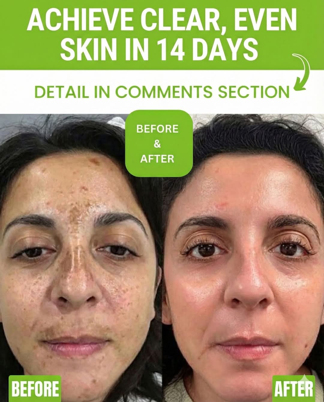 ACHIEVE CLEAR, EVEN SKIN IN JUST 14 DAYS