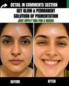 Get Glow and Permanent Solution of Pigmentation – Apply for 2 Weeks