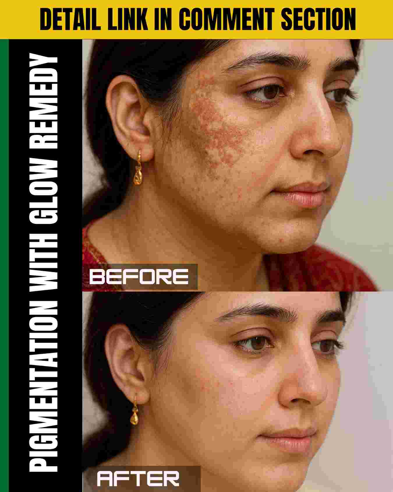 Pigmentation With Glow Remedy – Natural Solutions by Skin Type