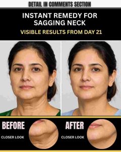INSTANT REMEDY FOR SAGGING NECK