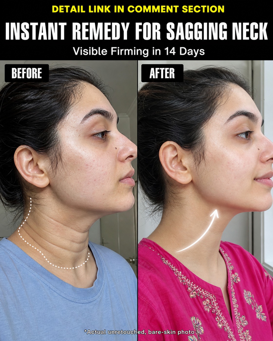 Instant Remedy for Sagging Neck – Firmer Looking Neck in 14 Days Naturally