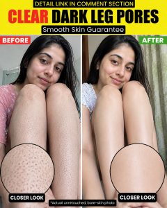 Clear Dark Leg Pores Naturally – Smooth and Healthy Legs at Home