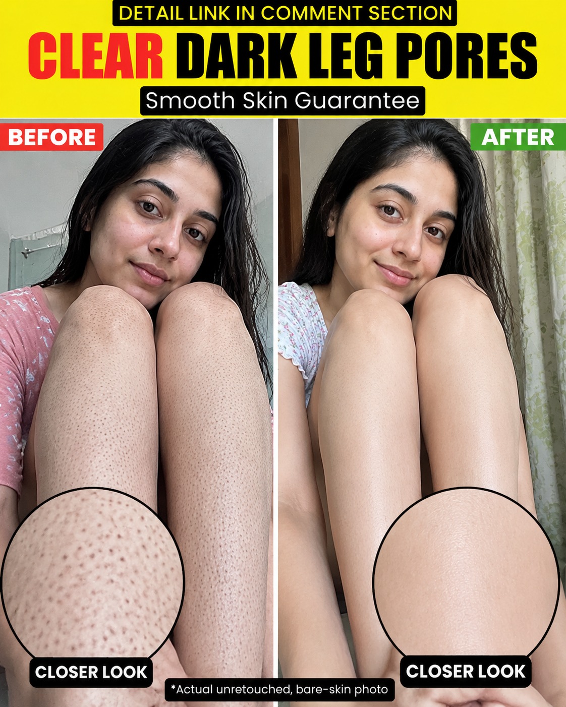 Clear Dark Leg Pores Naturally – Smooth and Healthy Legs at Home