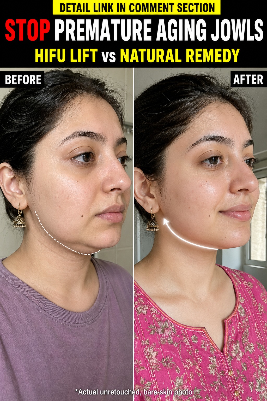 Stop Premature Aging Jowls Naturally HIFU Lift vs Natural Remedy