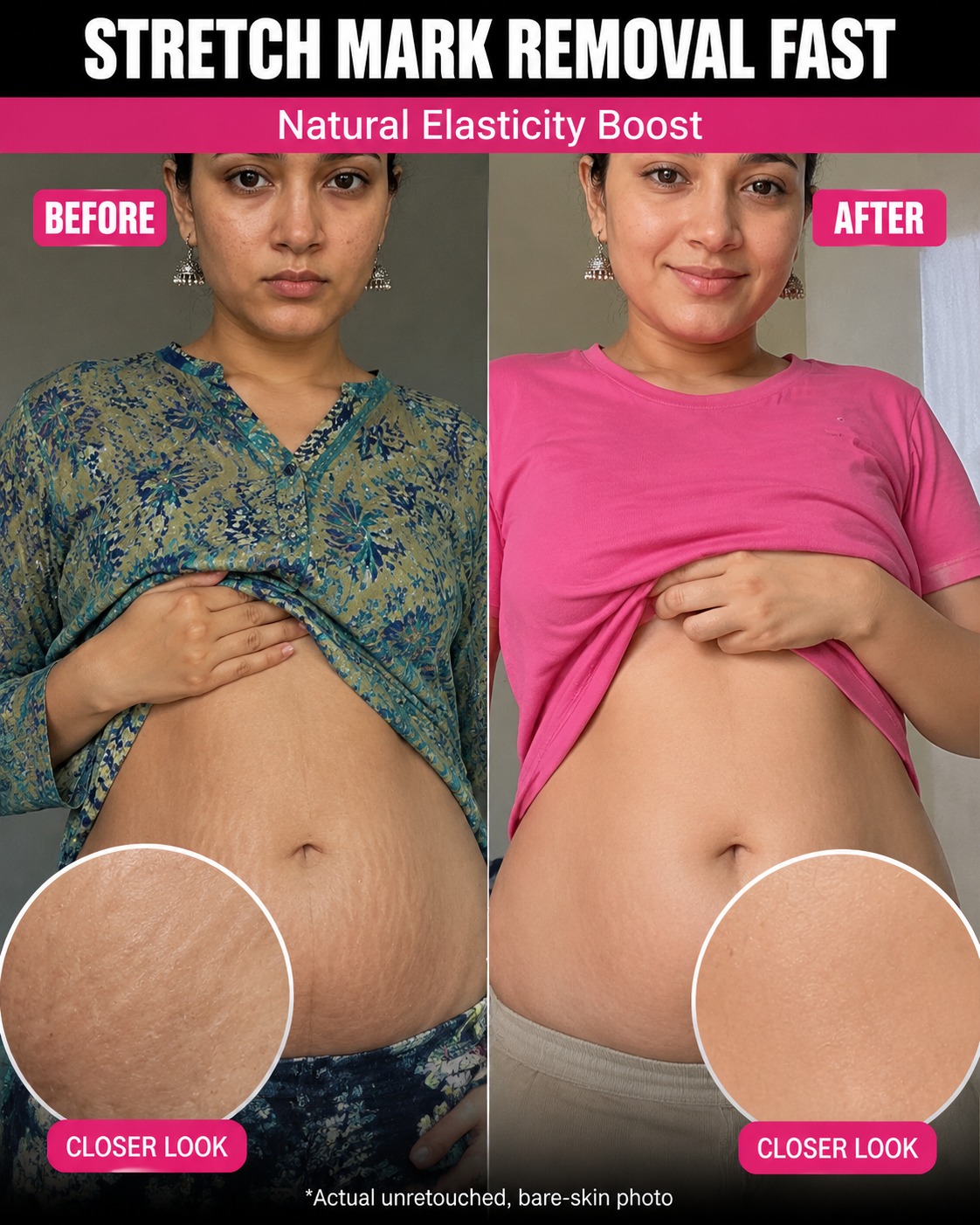 Stretch Mark Removal Fast Using Natural Elasticity Boost Remedies