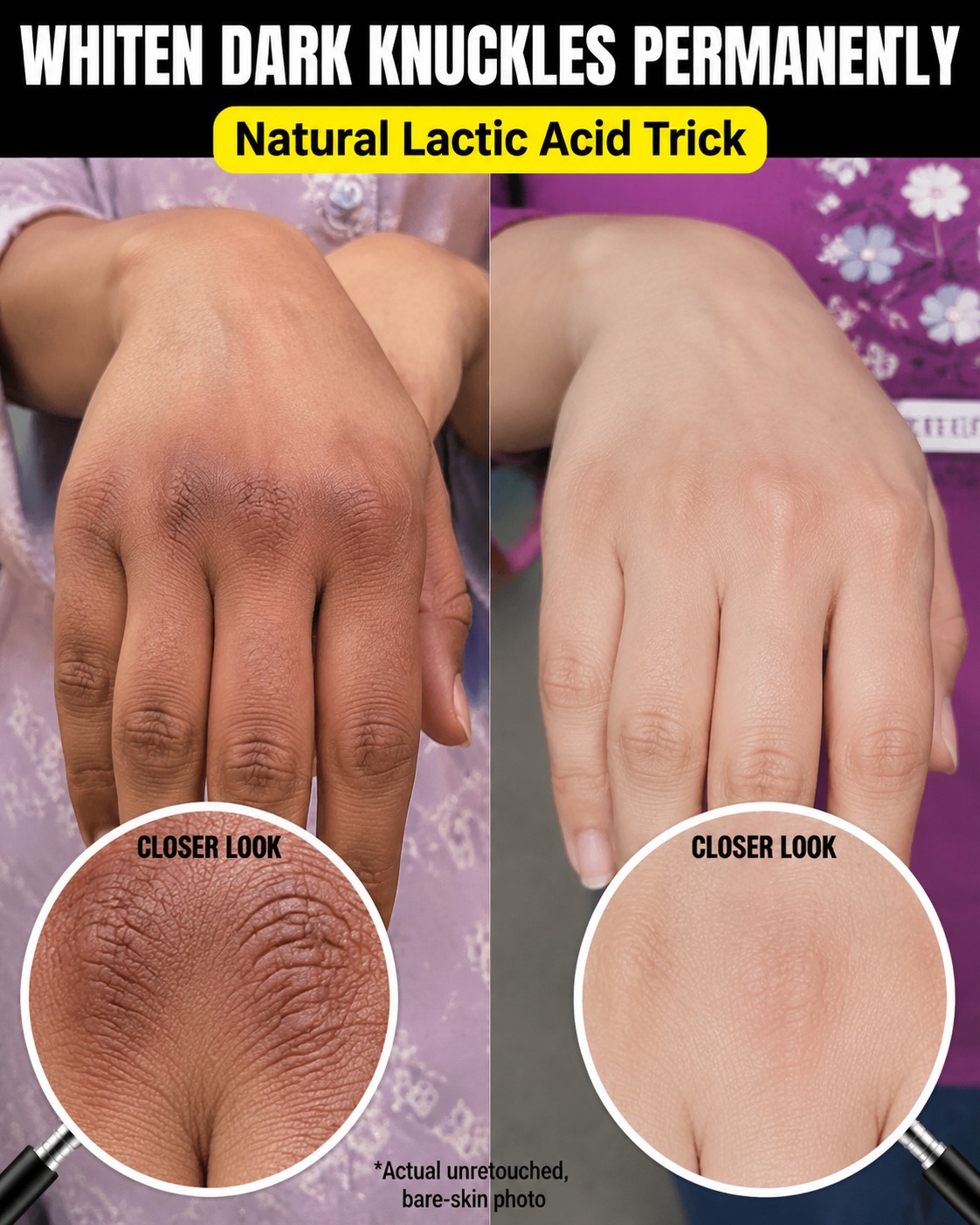 WHITEN DARK KNUCKLES NATURALLY WITH THESE SIMPLE HOME REMEDIES