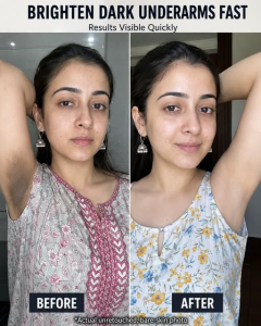 Brighten Dark Underarms Fast: Natural Remedies by Skin Type