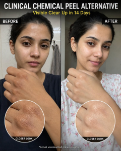 Clinical Chemical Peel Alternative: Naturally Brighten and Smooth Your Skin in 14 Days