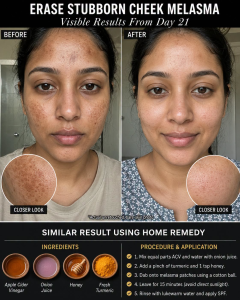 # Erase Stubborn Cheek Melasma Naturally: Visible Results From Day 21

Cheek melasma appears as brown, gray-brown, or muddy patches on the face, most commonly on sun-exposed areas such as the cheeks, forehead, upper lip, and nose. It can affect confidence because the marks often look uneven even after washing the face or applying makeup. Melasma is not simply “dirt” or surface tanning; it involves overactive pigment-producing cells called melanocytes, and it is strongly influenced by sunlight, visible light, heat, hormones, pregnancy, certain medicines, and genetics. Natural remedies can support a brighter, calmer skin tone, but melasma usually needs patience. A realistic target is softer, more even-looking skin in the first few days and visible pigment improvement after about 3–6 weeks when combined with strict sunscreen use. Dermatology sources emphasize that sun protection is essential because UV and visible light can worsen melasma and trigger relapse. ([American Academy of Dermatology][1])

## Remedy 1: For Normal Skin

### Ingredients

1 teaspoon licorice root powder or strong licorice tea: Licorice contains glabridin, which helps reduce excess melanin formation by influencing tyrosinase activity.

2 teaspoons fresh aloe vera gel: Aloe contains aloin and polysaccharides that hydrate and may support pigment-calming activity.

1 teaspoon plain yogurt: Natural lactic acid gently removes dull surface cells and improves smoothness.

1 teaspoon raw honey: Acts as a humectant, keeping the skin soft and less irritated.

1 tablespoon cooled green tea: Green tea catechins provide antioxidant support against light-related oxidative stress.

1 teaspoon rice water: Rice starch gives a soft, smooth feel and supports mild brightness.

### Scientific Working of This Remedy

Licorice and green tea are used in hyperpigmentation care because they help calm pigment-triggering pathways and oxidative stress. Aloe vera has clinical evidence in melasma when used in enhanced delivery forms, while yogurt’s lactic acid improves surface dullness. Honey and rice water keep the barrier comfortable so the skin does not become irritated, because irritation can make pigmentation look darker. ([PubMed][2])

### Procedure

Mix all ingredients into a smooth, thin paste. Apply only on the cheek melasma patches and nearby uneven areas. Leave for 10 minutes. Rinse with cool water and apply a gentle moisturizer. Use sunscreen in the daytime.

### How Often to Apply

Apply once daily for 5 days, then continue 4 times weekly for 21 days.

### Initial Results

Within 1–3 days, the skin may look calmer, smoother, and less dull. Pigment fading usually starts slowly after 2–3 weeks.

## Remedy 2: For Combination Skin

### Ingredients

1 teaspoon licorice tea concentrate: Helps target uneven brown patches gently.

1 teaspoon colloidal oatmeal: Protects dry cheek areas and reduces irritation.

1 tablespoon cooled green tea: Refreshes oily zones and adds antioxidant support.

2 teaspoons aloe vera gel: Hydrates without heaviness.

Half teaspoon cucumber juice: Cools skin that becomes warm or flushed.

3 drops jojoba oil: Softens dry patches without making the T-zone greasy.

### Scientific Working of This Remedy

Combination skin needs pigment support without drying out the cheeks. Licorice works on excess melanin pathways, green tea fights oxidative stress, aloe and cucumber reduce heat and dehydration, oatmeal protects the barrier, and jojoba oil prevents dry flakes around the cheekbones. A stable skin barrier is important because harsh scrubbing, vinegar, lemon, and irritation can worsen post-inflammatory pigmentation.

### Procedure

Mix the ingredients into a light gel-mask. Apply a medium layer on cheek patches and a very thin layer near the nose if oily. Leave for 8–10 minutes. Rinse gently without rubbing.

### How Often to Apply

Use on alternate days for the first week, then 4 times weekly until day 21.

### Initial Results

By day 2 or 3, cheeks may feel less tight and the T-zone may look less shiny. Melasma patches may look slightly softer as inflammation and dullness reduce.

## Remedy 3: For Oily Skin

### Ingredients

1 tablespoon strong cooled green tea: Helps reduce oxidative stress and greasy appearance.

1 teaspoon aloe vera gel: Provides non-greasy hydration.

Half teaspoon kaolin clay: Absorbs excess oil without being too harsh.

Half teaspoon licorice powder: Supports gentle brightening of dark patches.

A tiny pinch of turmeric: Curcumin has antioxidant and tyrosinase-inhibiting potential, but use very little to avoid staining.

Half teaspoon raw honey: Prevents clay from over-drying the skin.

### Scientific Working of This Remedy

Oily skin can make melasma look more visible because oil reflects light and dead cells collect on the surface. Kaolin reduces excess oil, green tea provides antioxidant protection, licorice and turmeric support pigment-calming activity, aloe hydrates, and honey keeps the mask gentle. Research reviews on natural hyperpigmentation ingredients discuss green tea, licorice, turmeric, and aloe as supportive options, though they are not instant cures. ([PMC][3])

### Procedure

Mix everything into a thin paste. Apply only to the cheeks and oily pigmented zones. Leave for 6–8 minutes. Do not let the clay fully crack. Rinse with cool water and moisturize lightly.

### How Often to Apply

Apply once daily for 3 days, then every other day for 21 days.

### Initial Results

In 1–3 days, oiliness may reduce and the skin may look clearer. Pigment changes usually need at least 21 days of careful use plus sunscreen.

## Remedy 4: For Dry Skin

### Ingredients

2 teaspoons aloe vera gel: Adds water-based hydration and soothing support.

1 teaspoon licorice tea concentrate: Helps reduce the appearance of uneven pigmentation.

1 teaspoon raw honey: Pulls moisture into the skin surface.

1 teaspoon finely ground oatmeal: Calms roughness and barrier dryness.

3 drops rosehip seed oil: Supplies essential fatty acids for softness and glow.

Half teaspoon plain yogurt: Gives mild lactic-acid smoothing when used carefully.

### Scientific Working of This Remedy

Dry skin makes melasma patches look darker because rough, dehydrated skin scatters light unevenly. Aloe and honey hydrate, oatmeal protects the barrier, rosehip oil softens dry texture, yogurt gently lifts dull cells, and licorice targets excess pigment. This remedy focuses on slow brightening without stripping the skin.

### Procedure

Mix aloe, licorice tea, honey, oatmeal, yogurt, and rosehip oil. Apply to clean cheeks for 10–12 minutes. Rinse gently and moisturize while the skin is still slightly damp.

### How Often to Apply

Use daily for 5 days, then 3–4 times weekly for 4–6 weeks.

### Initial Results

Dryness and roughness may improve within 1–2 days. By day 21, patches may look less harsh if sun exposure is controlled.

## Remedy 5: For Sensitive Skin

### Ingredients

1 tablespoon colloidal oatmeal: Soothes and protects the skin barrier.

2 teaspoons aloe vera gel: Cools and hydrates sensitive skin.

1 teaspoon very diluted licorice tea: Gives gentle pigment support without strong exfoliation.

1 teaspoon rice water: Softens the skin surface.

Half teaspoon raw honey: Adds mild hydration.

1 teaspoon boiled cooled water: Dilutes the mixture to reduce irritation risk.

### Scientific Working of This Remedy

Sensitive skin should avoid apple cider vinegar, onion juice, lemon, baking soda, harsh scrubs, and strong turmeric masks. These can irritate the skin and may worsen pigmentation. Oatmeal calms the barrier, aloe hydrates, licorice supports gentle brightening, rice water softens, honey holds moisture, and water keeps the remedy mild.

### Procedure

Mix all ingredients into a thin soothing mask. Patch test first on the jawline for 24 hours. If safe, apply to cheek melasma for 5–7 minutes only. Rinse with cool water and apply a bland moisturizer.

### How Often to Apply

Use once daily for 3 days. If there is no redness or burning, continue 2–3 times weekly for 21 days.

### Initial Results

Sensitive skin may feel calmer within 1–2 days. Fading should be gradual; stop immediately if burning, itching, swelling, or rash appears.

## Final Tips

Do not expect melasma to disappear overnight. Fresh, mild pigmentation may respond faster, but stubborn cheek melasma often needs 8–12 weeks of consistent care. The most important step is daily sunscreen. Use broad-spectrum SPF 30 or higher every morning, reapply when outdoors, wear a hat, and avoid midday sun and heat. For melasma-prone skin, tinted sunscreen with iron oxides can be especially helpful because visible light also contributes to pigmentation. Clinical studies show that sunscreen protecting against both UV and visible light performs better for melasma than UV-only protection. ([PubMed][4])

Keep skincare simple, stay hydrated, sleep well, clean makeup tools, avoid picking or rubbing the cheeks, and never use strong acids or kitchen vinegar on the face. Visible improvements usually begin within 2–3 days as dryness and dullness reduce, while clearer tone and melasma softening usually appear around day 21 and continue over several weeks. If melasma spreads quickly, appears during pregnancy, follows medication use, becomes very dark, or does not improve after 8–12 weeks, see a dermatologist.

## Diet Plan for Melasma and Uneven Pigmentation

Continue this diet plan for at least 6–8 weeks along with the suitable remedy.

Morning: Drink water and eat oats, eggs, yogurt, chia seeds, or lentils. Add vitamin C-rich fruit such as guava, orange, kiwi, berries, or amla to support antioxidant protection.

Lunch: Eat lentils, beans, chicken, fish, tofu, or chickpeas with brown rice or whole wheat roti. Add spinach, cucumber, carrots, tomatoes, capsicum, and coriander.

Snack: Choose almonds, walnuts, pumpkin seeds, sunflower seeds, apple, pomegranate, or unsweetened yogurt.

Dinner: Keep it light with vegetable soup, grilled protein, lentils, fish, or tofu with a small serving of whole grains.

Avoid frequent sugary drinks, deep-fried snacks, crash dieting, and excess processed foods because inflammation and unstable blood sugar may worsen dullness and breakouts. If the problem persists, becomes severe, or affects your confidence, consult a dermatologist for proper diagnosis and evidence-based treatment.

## References for the above remedy

1. American Academy of Dermatology Association. “Melasma: Self-care.” URL: [https://www.aad.org/public/diseases/a-z/melasma-self-care](https://www.aad.org/public/diseases/a-z/melasma-self-care)

2. DermNet. “Melasma.” URL: [https://dermnetnz.org/topics/melasma](https://dermnetnz.org/topics/melasma)

3. Castanedo-Cazares, J. P., et al. “Near-visible light and UV photoprotection in the treatment of melasma.” URL: [https://pubmed.ncbi.nlm.nih.gov/24313385/](https://pubmed.ncbi.nlm.nih.gov/24313385/)

4. Bernstein, E. F., et al. “Iron oxides in novel skin care formulations attenuate blue light for enhanced protection against skin damage.” URL: [https://pmc.ncbi.nlm.nih.gov/articles/PMC7894303/](https://pmc.ncbi.nlm.nih.gov/articles/PMC7894303/)

5. Hollinger, J. C., et al. “Are Natural Ingredients Effective in the Management of Hyperpigmentation? A Systematic Review.” URL: [https://pmc.ncbi.nlm.nih.gov/articles/PMC5843359/](https://pmc.ncbi.nlm.nih.gov/articles/PMC5843359/)

6. Ghafarzadeh, M., & Eatemadi, A. “Clinical efficacy of liposome-encapsulated Aloe vera on melasma treatment during pregnancy.” URL: [https://pubmed.ncbi.nlm.nih.gov/28139161/](https://pubmed.ncbi.nlm.nih.gov/28139161/)

7. Sarkar, R., et al. “Cosmeceuticals for Hyperpigmentation: What is Available?” URL: [https://pmc.ncbi.nlm.nih.gov/articles/PMC3663177/](https://pmc.ncbi.nlm.nih.gov/articles/PMC3663177/)

8. Thawabteh, A. M., et al. “Skin Pigmentation Types, Causes and Treatment—A Review.” URL: [https://www.mdpi.com/1420-3049/28/12/4839](https://www.mdpi.com/1420-3049/28/12/4839)

9. Austin, E., et al. “Topical Treatments for Melasma: A Systematic Review of Randomized Controlled Trials.” URL: [https://pubmed.ncbi.nlm.nih.gov/31741361/](https://pubmed.ncbi.nlm.nih.gov/31741361/)

10. Baliña, L. M., & Graupe, K. “The treatment of melasma: 20% azelaic acid versus 4% hydroquinone cream.” URL: [https://pubmed.ncbi.nlm.nih.gov/1816137/](https://pubmed.ncbi.nlm.nih.gov/1816137/)

[1]: https://www.aad.org/public/diseases/a-z/melasma-self-care?utm_source=chatgpt.com "Melasma: Self-care"
[2]: https://pubmed.ncbi.nlm.nih.gov/28139161/?utm_source=chatgpt.com "Clinical efficacy of liposome-encapsulated Aloe vera on ..."
[3]: https://pmc.ncbi.nlm.nih.gov/articles/PMC5843359/?utm_source=chatgpt.com "Are Natural Ingredients Effective in the Management of ... - PMC"
[4]: https://pubmed.ncbi.nlm.nih.gov/24313385/?utm_source=chatgpt.com "Near-visible light and UV photoprotection in the treatment ..."
