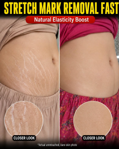 Stretch Mark Removal Fast: Natural Elasticity Boost Remedies by Skin Type
