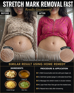 Stretch Mark Removal Fast: Natural Home Remedies to Fade Their Appearance Safely