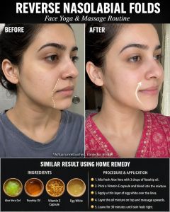 Reverse Nasolabial Folds Naturally with Face Yoga, Massage, and Home Remedies
