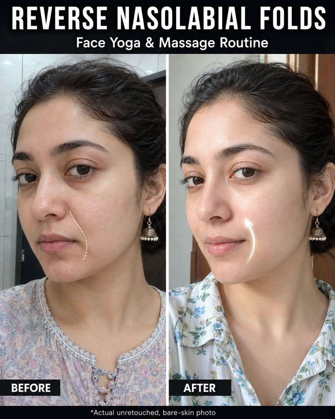 Reverse Nasolabial Folds Naturally: Face Yoga, Massage, and Skin-Type Remedies