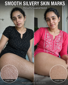 Smooth Silvery Skin Marks Naturally: 5 Skin-Type Home Remedies for Stretch Marks